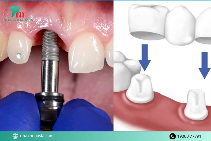 Quy trình cấy răng hàm bị sâu diễn ra như thế nào?