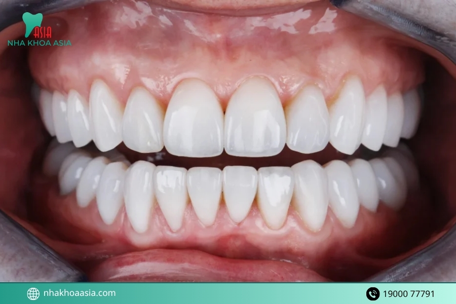 Cấy răng hàm bị sâu có đau không? Bao lâu thì ăn nhai được?