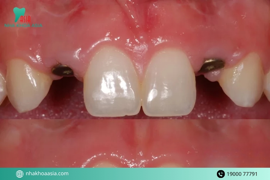 Những rủi ro có thể gặp nếu cấy răng hàm bị sâu sai cách