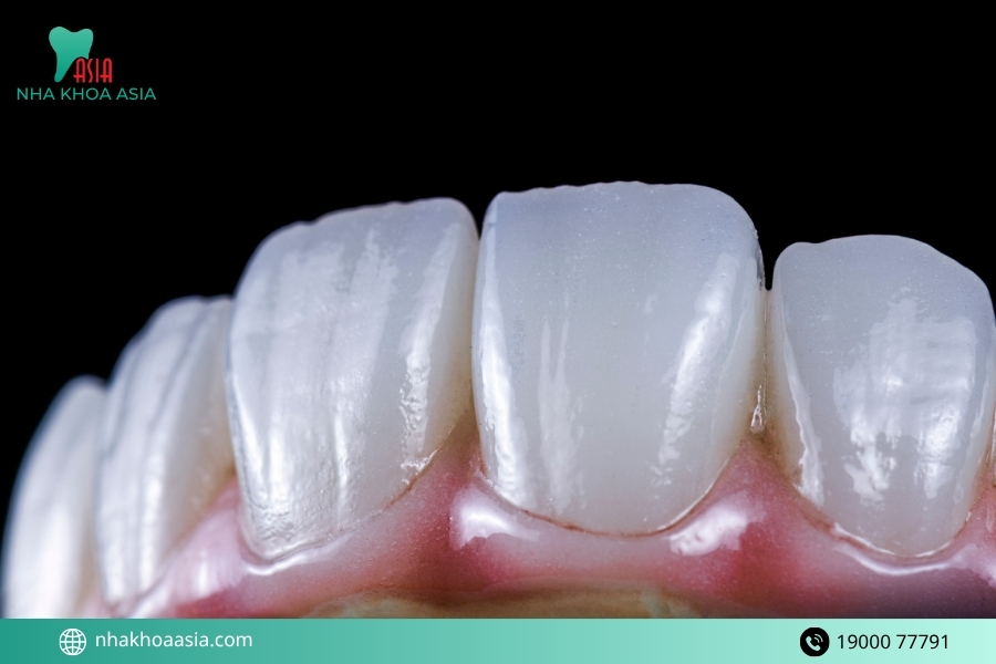 Nên cấy răng hàm bị sâu ở đâu uy tín và chất lượng?