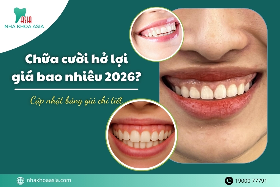 Chữa cười hở lợi giá bao nhiêu 2026? Cập nhật bảng giá chi tiết