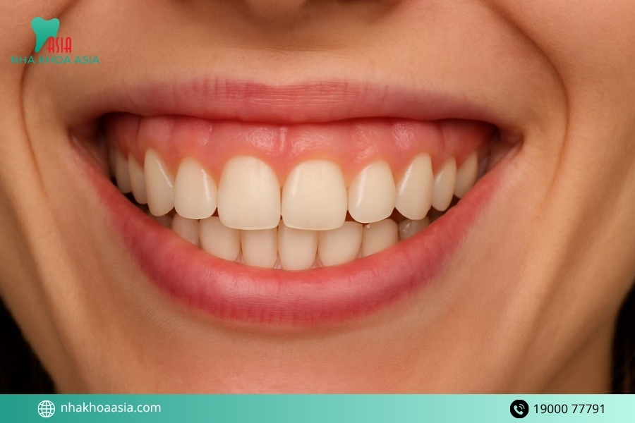 Sau khi phẫu thuật cười hở lợi có cần phải kiêng khem gì không? 