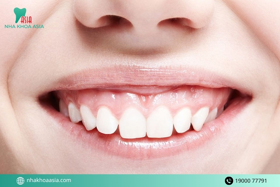 Thời gian điều trị cười hở lợi khoảng bao lâu? Bao lâu thì hồi phục?