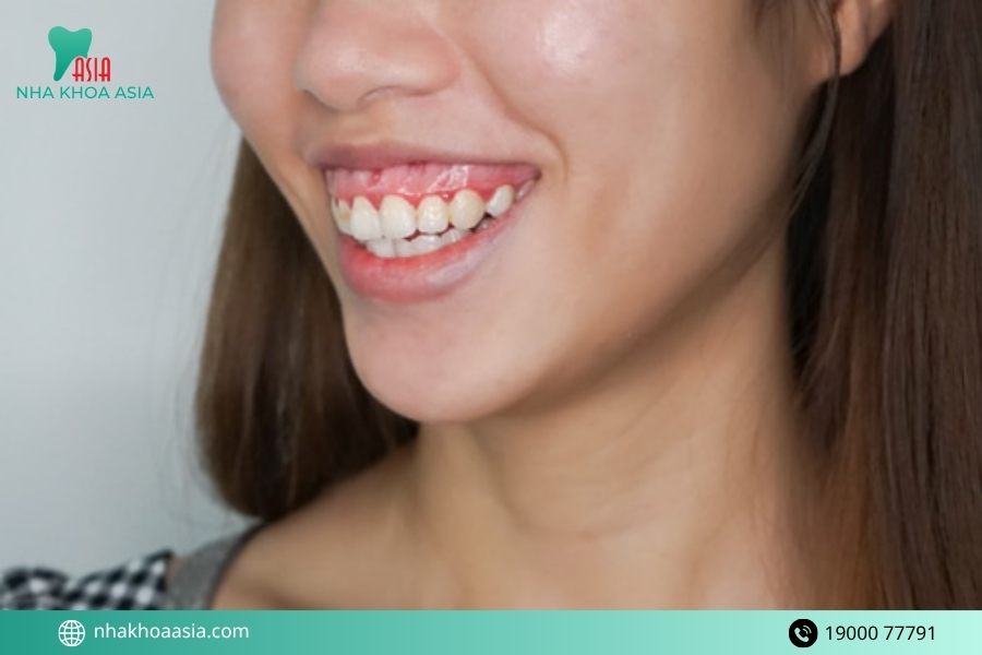 Những yếu tố ảnh hưởng đến chi phí chữa cười hở lợi lại chênh lệch nhiều?