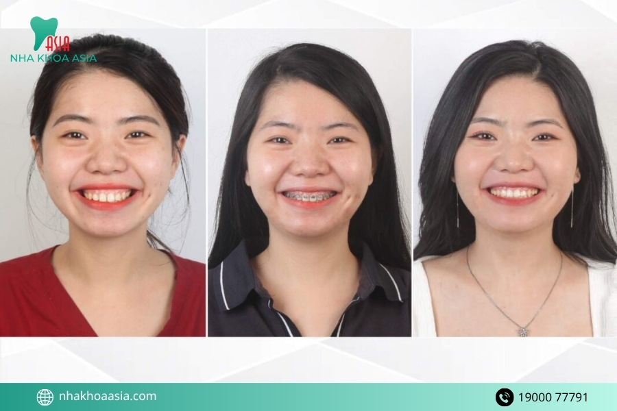 Nên chọn phương pháp nào để tối ưu chi phí?