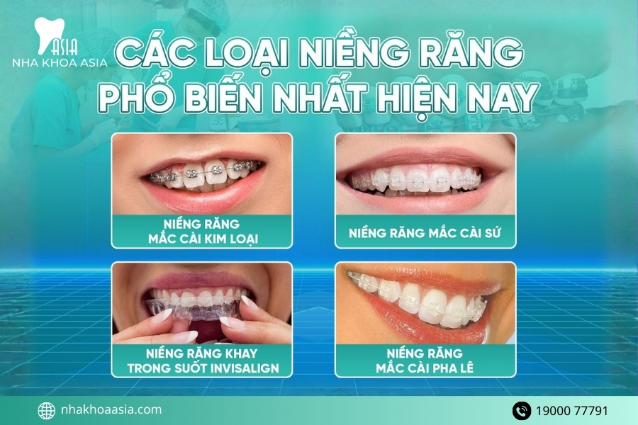 Có bao nhiêu loại mắc cài niềng răng?