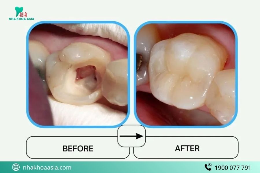 Có nên bọc sứ sau khi lấy tủy răng không?
