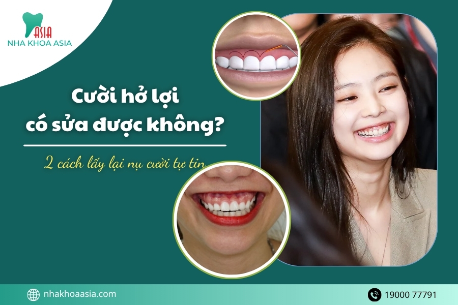 Cười hở lợi có sửa được không? 2 Cách giúp lấy lại nụ cười tự tin