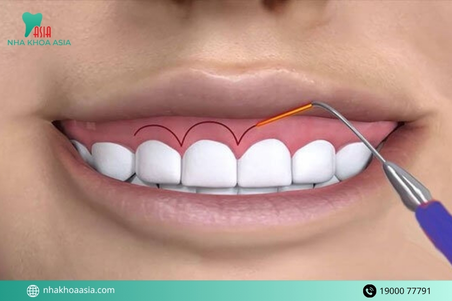 Những phương pháp sửa nụ cười hở lợi