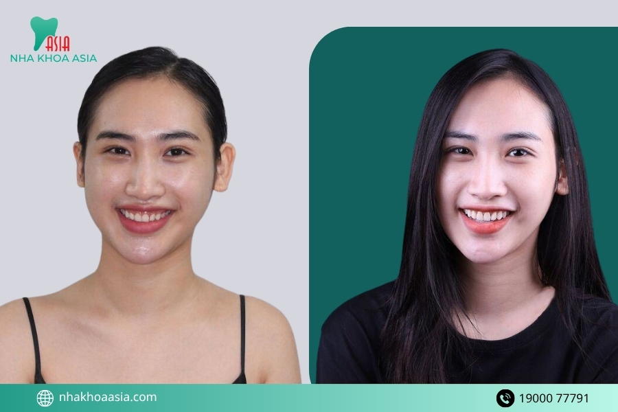 Sửa cười hở lợi có đau không? Có nguy hiểm không?
