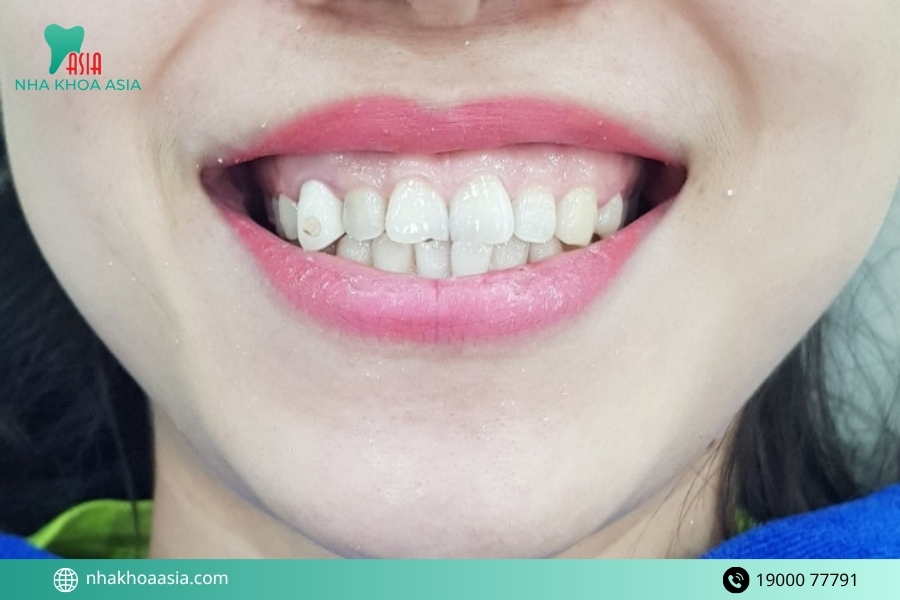 Nguyên nhân dẫn đến bị cười hở lợi