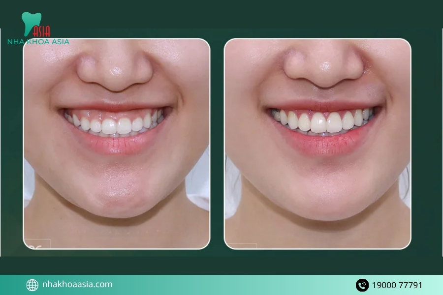 Rủi ro có thể xảy ra nếu điều trị cười hở lợi ở nha khoa không uy tín
