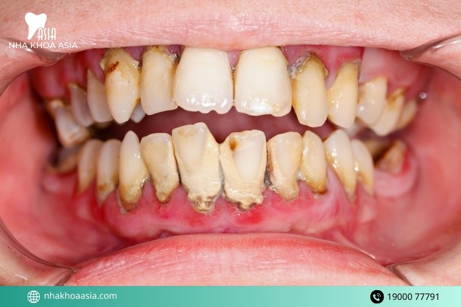 Dấu hiệu cho thấy bạn cần lấy cao răng ngay