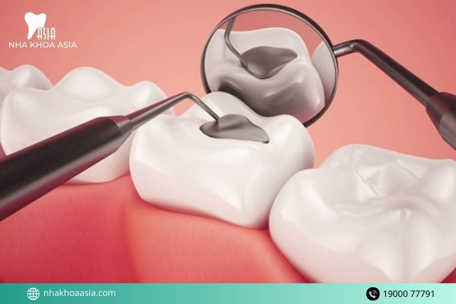 Dấu hiệu bị ê răng sau khi trám nào cần quay lại nha khoa thăm khám ngay?