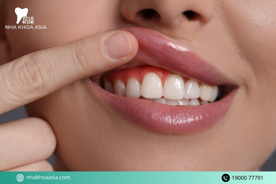 Dấu hiệu viêm nướu răng giai đoạn đầu