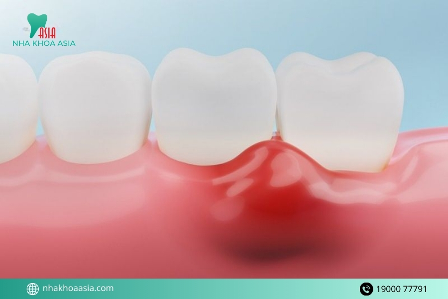 Dấu hiệu viêm nướu răng giai đoạn tiến triển
