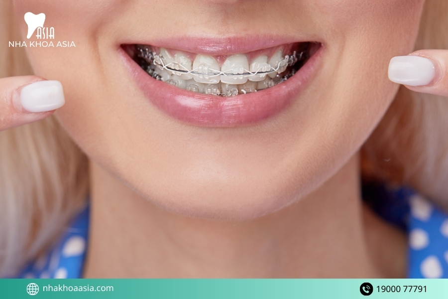 Có một số đối tượng dễ bị hóp má hơn khi niềng răng