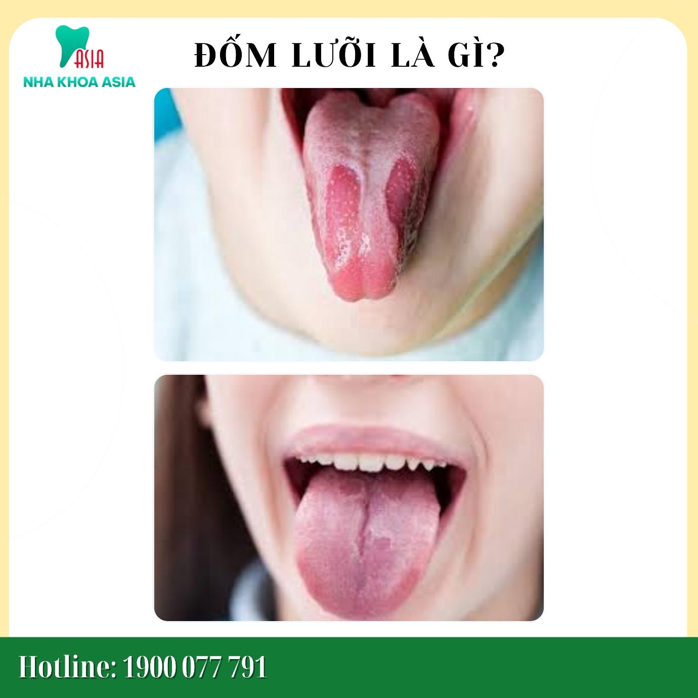Giới thiệu về hiện tượng đốm lưỡi