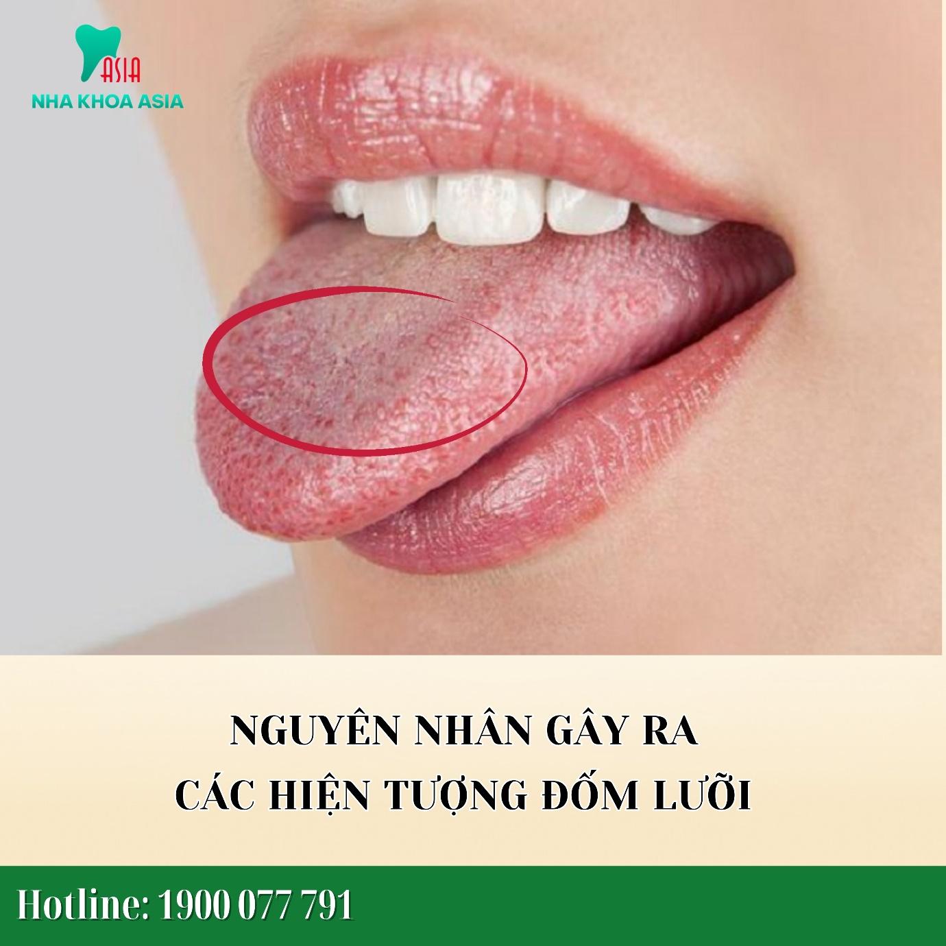 Nguyên nhân gây ra các hiện tượng đốm lưỡi