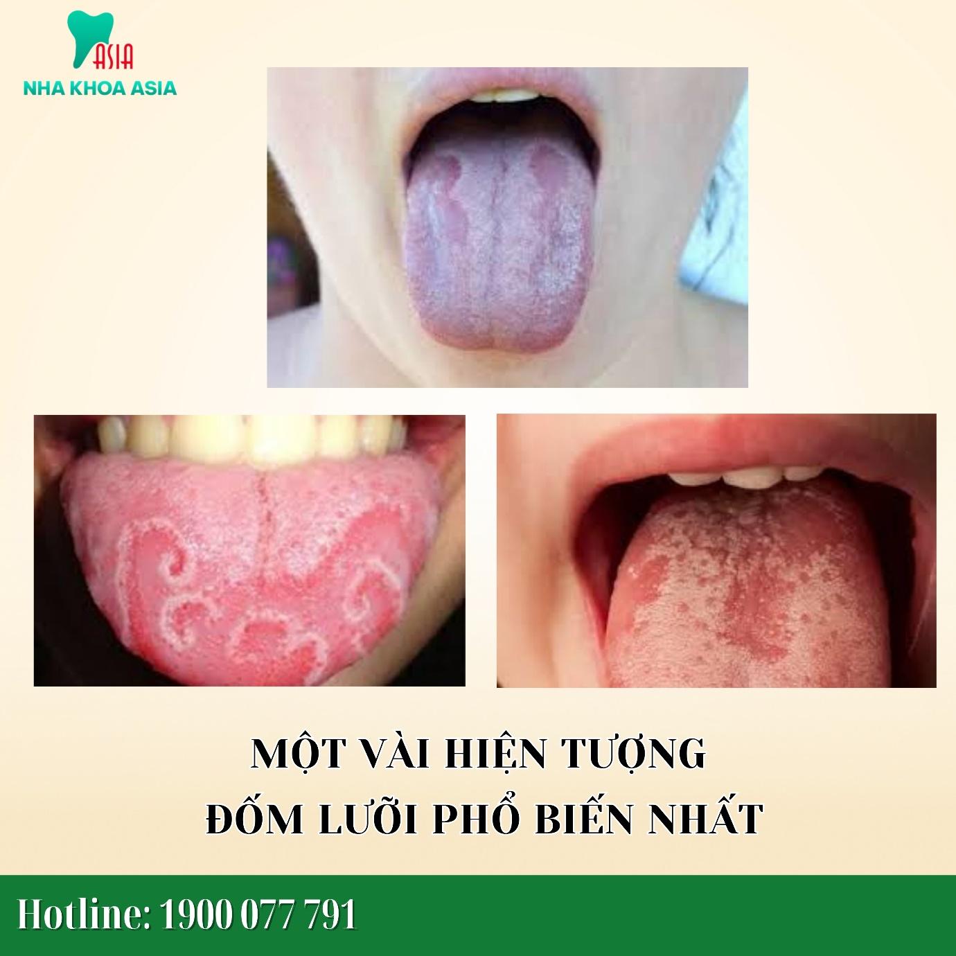 Một vài hiện tượng đốm lưỡi phổ biến nhất