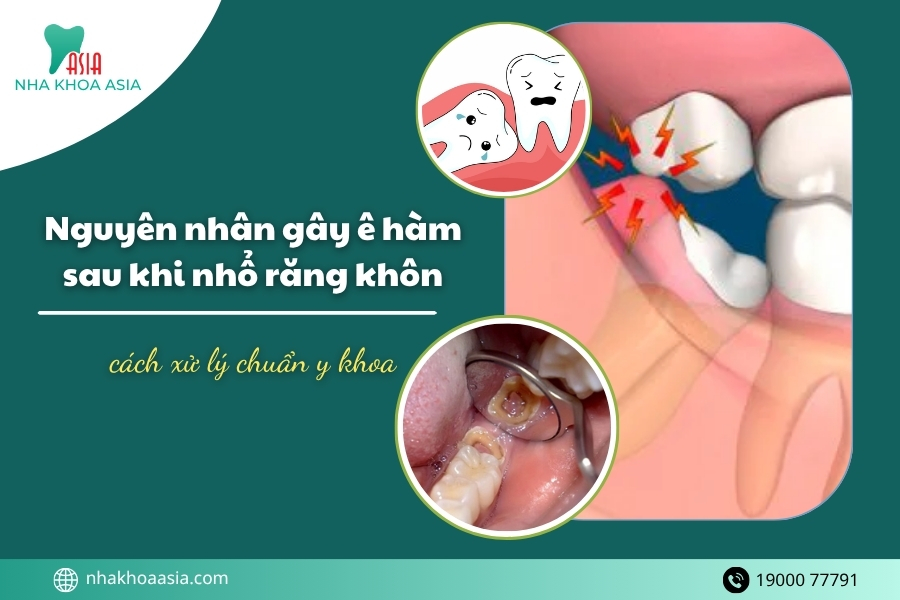 Nguyên nhân gây ê hàm sau khi nhổ răng khôn và cách xử lý chuẩn y khoa