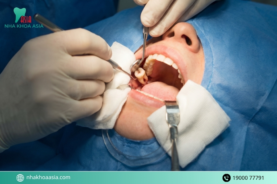  Các thực phẩm cần tránh ê hàm sau khi nhổ răng khôn