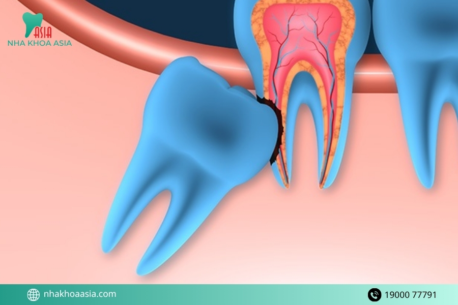 Các thực phẩm nên bổ sung khi bị ê hàm sau khi nhổ răng khôn