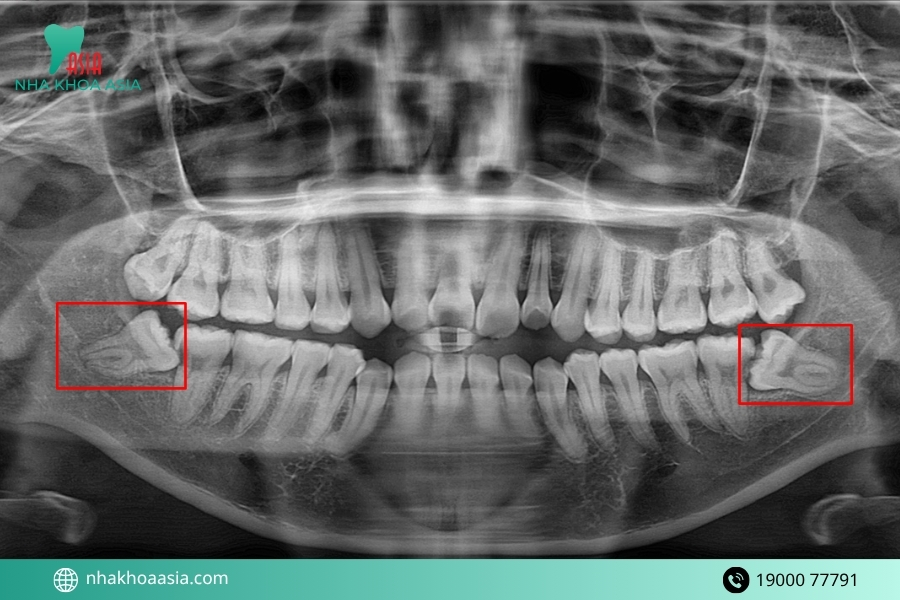 Cách xử lý ê hàm sau khi nhổ răng khôn theo khuyến cáo của bác sĩ