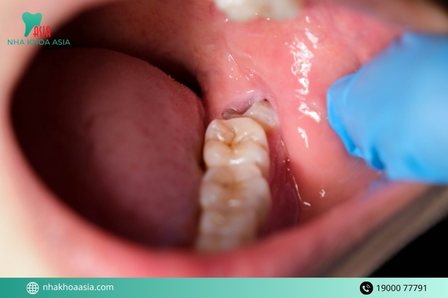 Các biến chứng có thể liên quan đến tình trạng ê hàm kéo dài