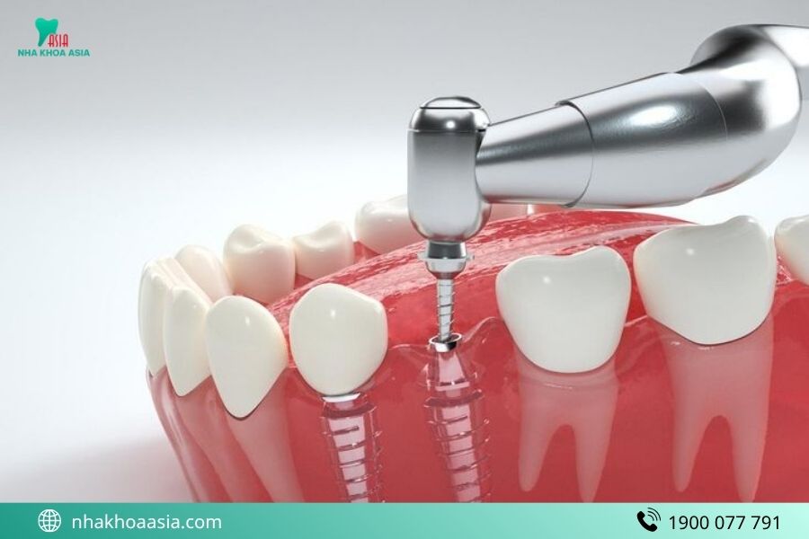 Giá trồng Implant là bao nhiêu