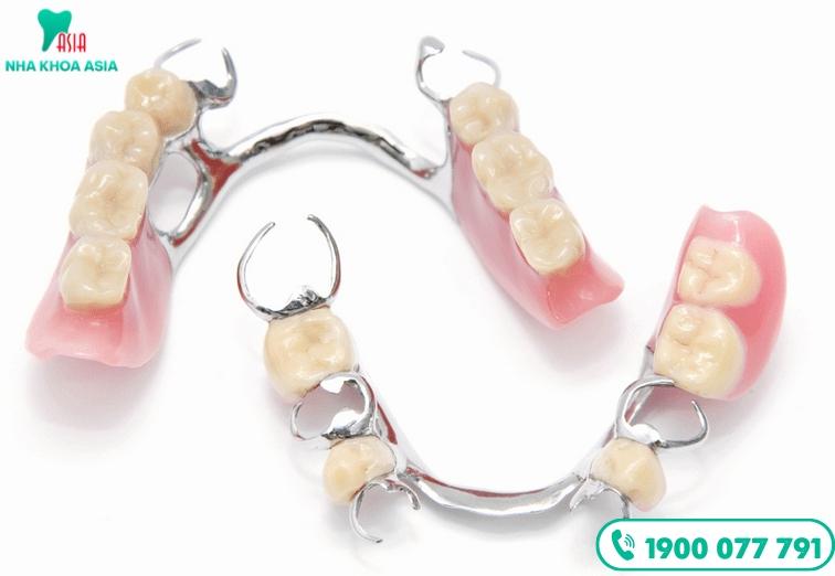 Hàm khung liên kết sử dụng khi mất răng, đảm bảo nhai và thẩm mỹ mà không cần phẫu thuật phức tạp