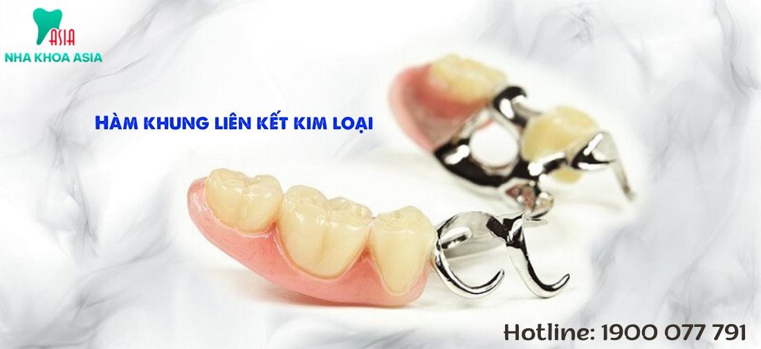 Hàm khung liên kết kim loại bền chắc, chi phí thấp nhưng kém thẩm mỹ hơn các loại khác