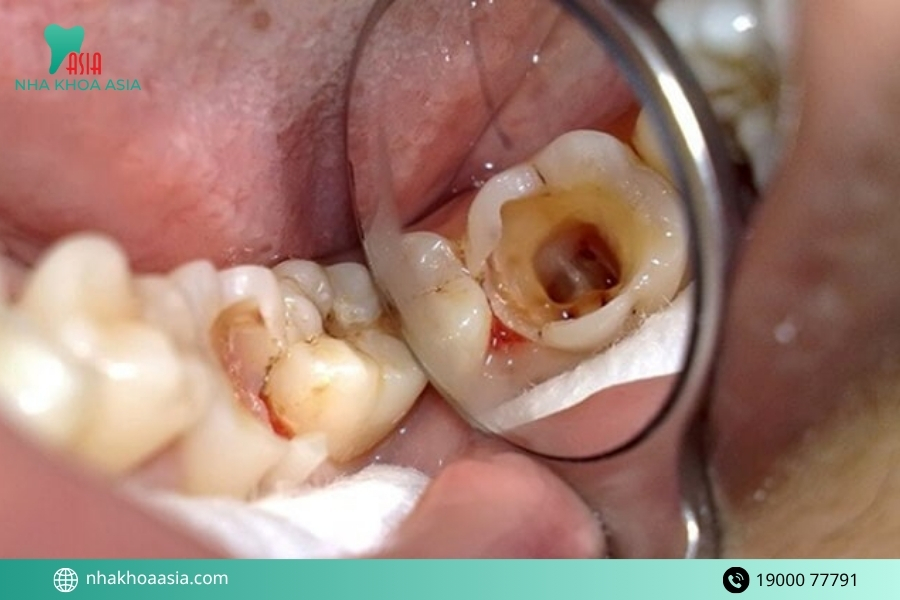 Hàn răng xong có bị sâu lại không?