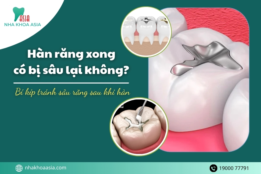 Hàn răng xong có bị sâu lại không? 5 cách bảo vệ nụ cười