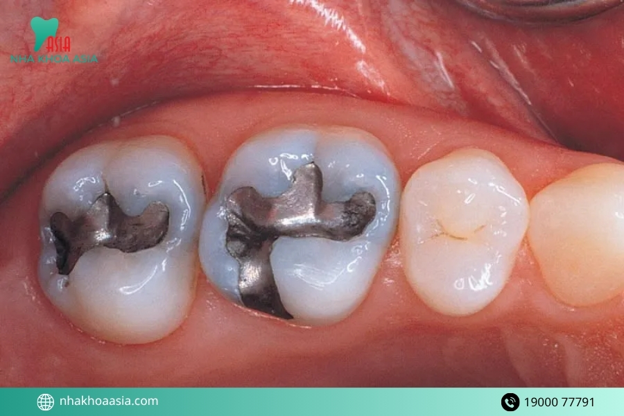 Những trường hợp khiến hàn răng xong vẫn bị sâu răng lại