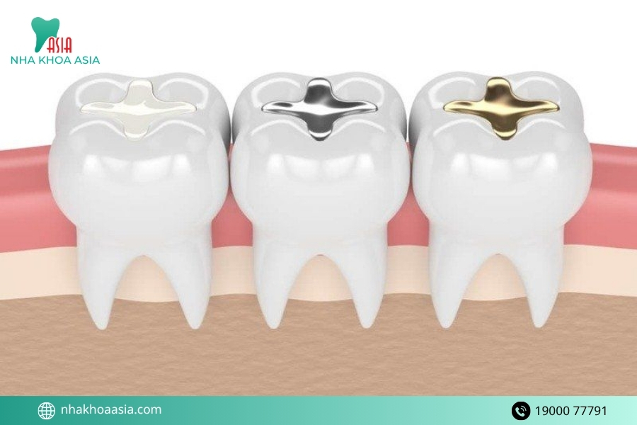 Các loại vật liệu trám răng phổ biến nhất hiện nay