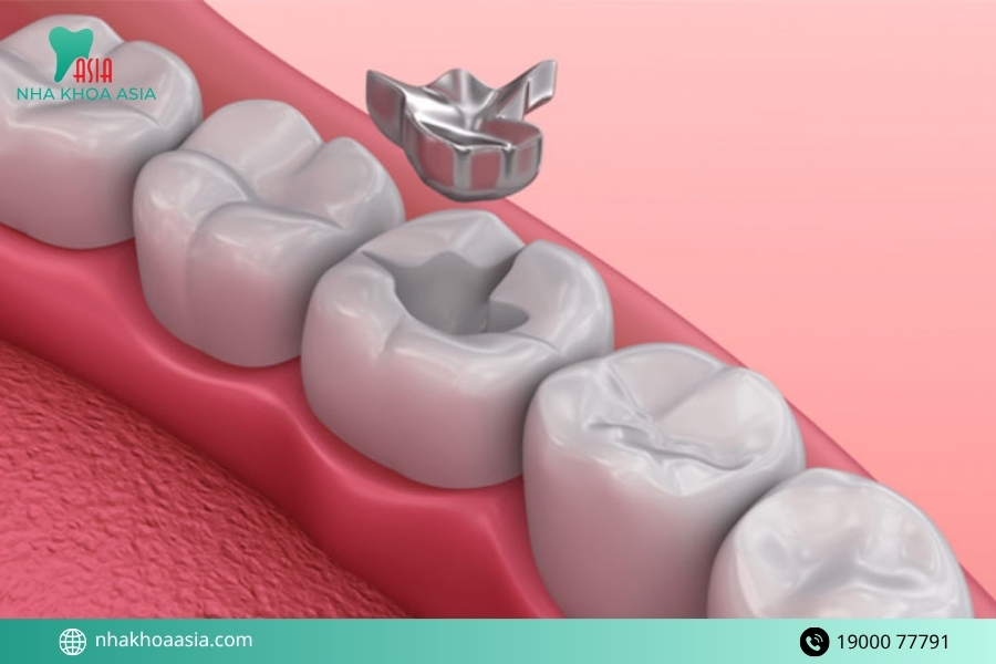 Những bí kíp bảo vệ răng sau khi hàn giúp ngăn ngừa sâu lại