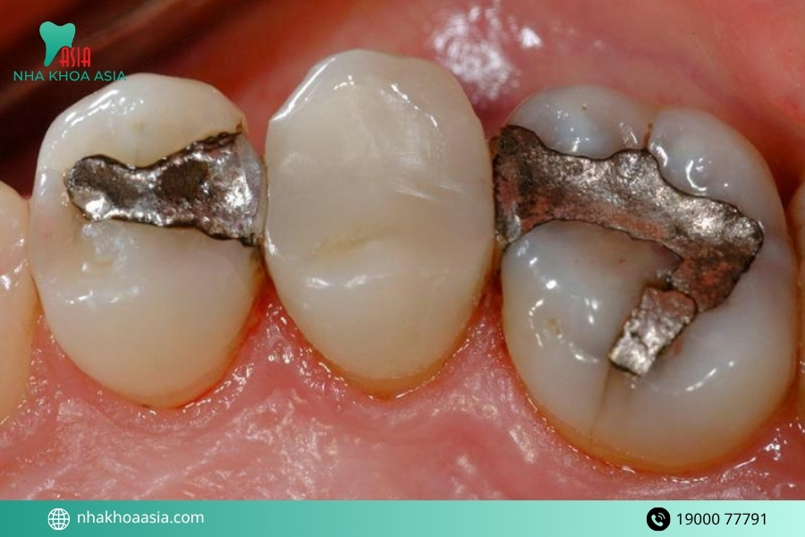 Dấu hiệu nhận biết răng hàn bị sâu lại
