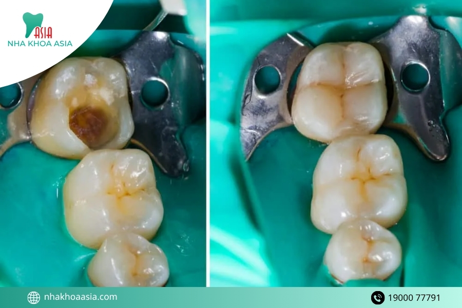 Những trường hợp nên đến nha khoa hàn răng ngay