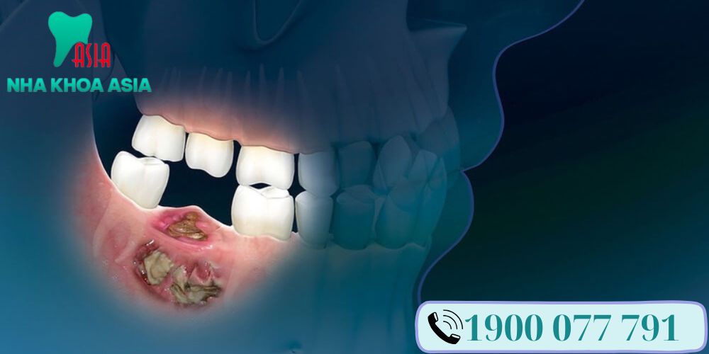 Những dấu hiệu giúp bạn có thể nhận ra mình bị hoại tử xương hàm