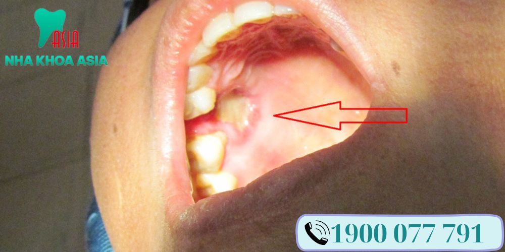 Có rất nhiều nguyên nhân dẫn đến bệnh hoại tử xương hàm