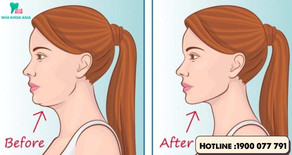 Jawline là đường viền xương hàm dưới, tạo nên cấu trúc khuôn mặt