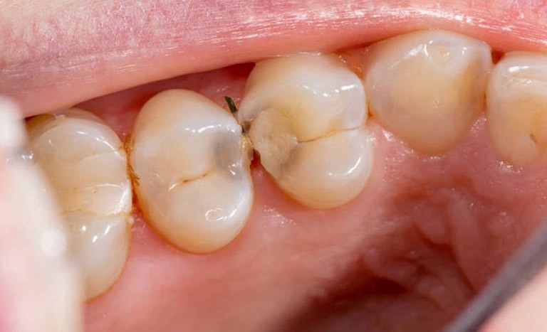 Nguyên nhân gây ra kẽ răng bị hôi