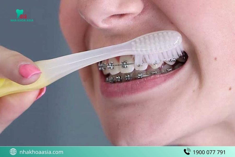 Kem đánh răng cho người niềng khác gì bình thường