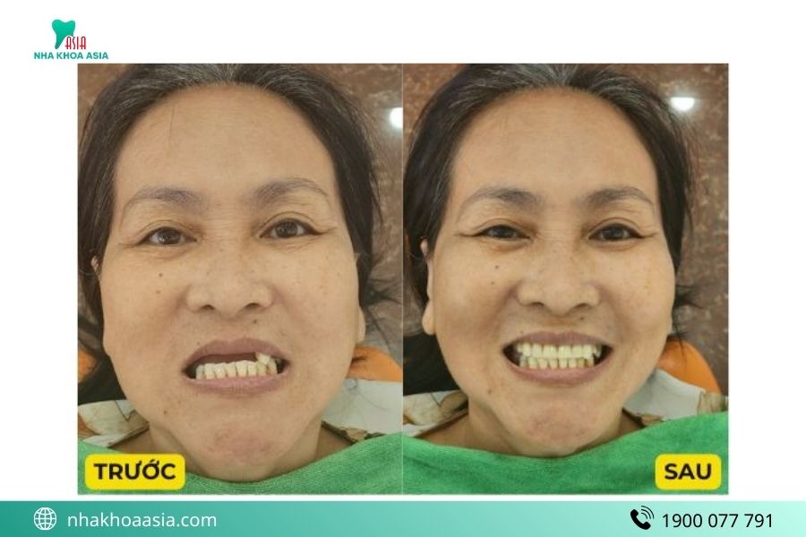 Khách hàng Nha Khoa Asia làm hàm giả tháo lắp