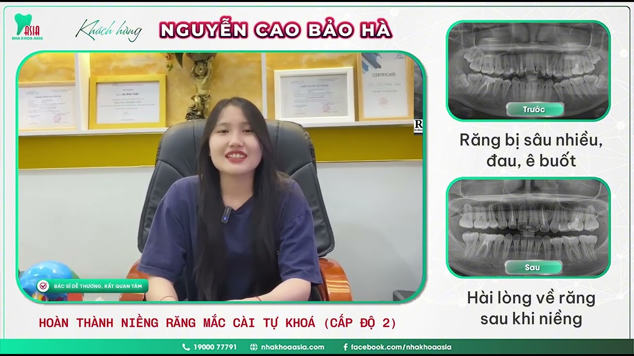 Khách hàng Nguyễn Cao Bảo Hà niềng răng mắc cài kim loại