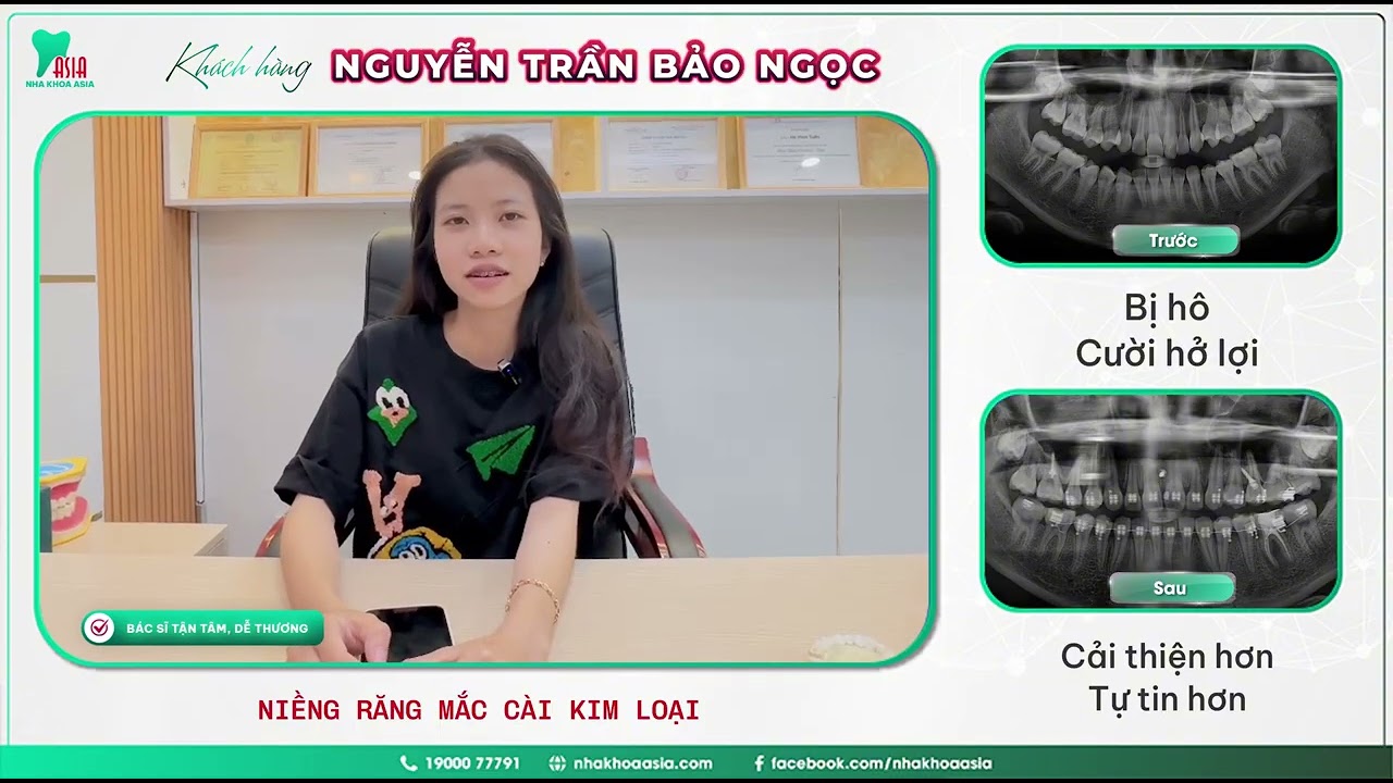 khách hàng Nguyễn Trần Bảo Ngọc niềng răng mắc cài kim loại