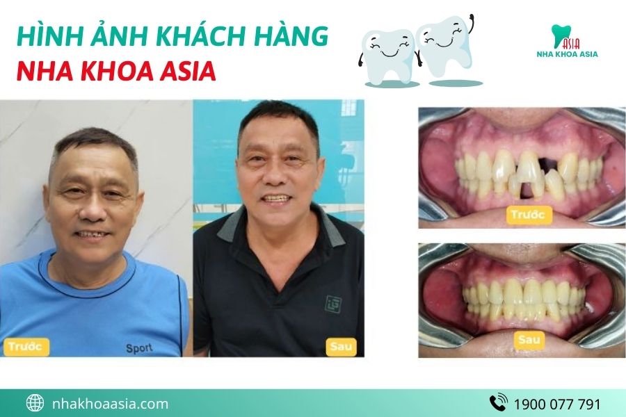 Khách hàng Nha Khoa Asia làm răng sứ