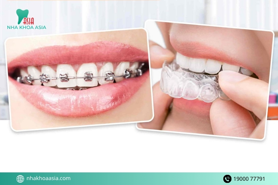Làm sao để niềng răng không bị hóp má?