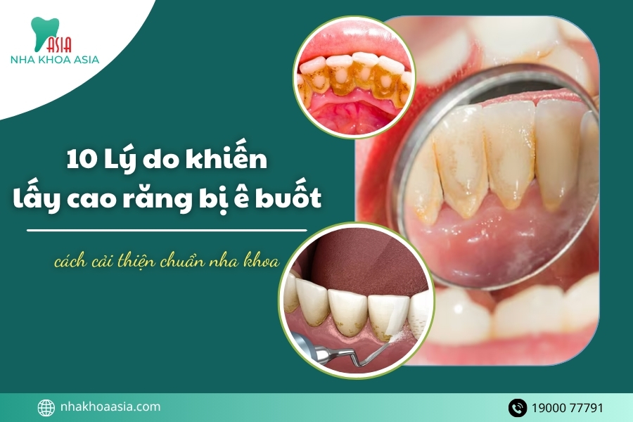 10 Lý do lấy cao răng bị ê buốt và cách cải thiện chuẩn nha khoa 2026